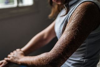 Ichtyóza - bolestivá nemoc, při které zarůstáte kůží. V Česku jí trpí asi 180 lidí - Proženy.cz